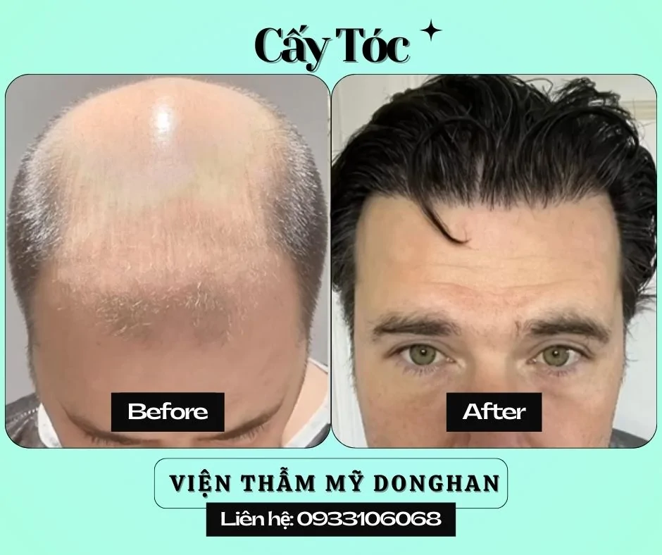Cắt Mí Thẩm Mỹ – Giải Pháp Tạo Đôi Mắt Hai Mí To Tròn, Rõ Nét