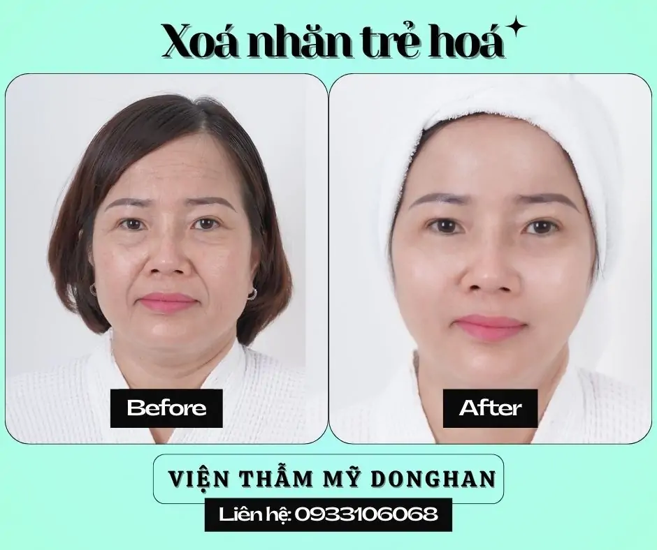 Cắt Mí Thẩm Mỹ – Giải Pháp Tạo Đôi Mắt Hai Mí To Tròn, Rõ Nét