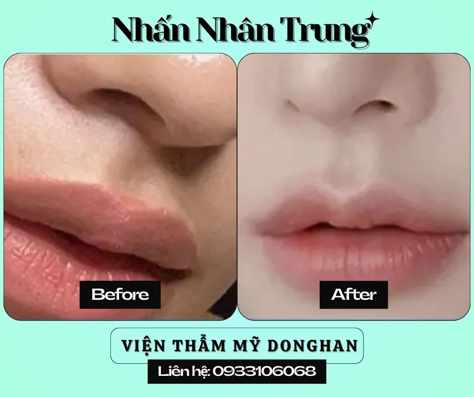 Cắt Mí Thẩm Mỹ – Giải Pháp Tạo Đôi Mắt Hai Mí To Tròn, Rõ Nét